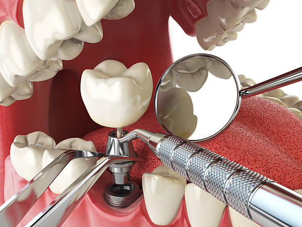 Best Emergency Broken Tooth Repair in South Bay, FL